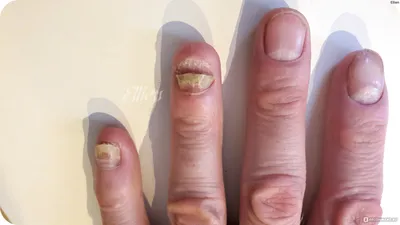 Фотографии грибка ногтей на руках в формате JPG