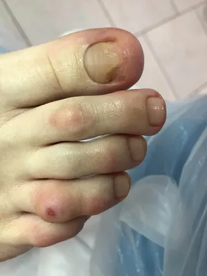 Как лечить грибок ногтей на руках: шаг за шагом (фото)