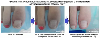Фото грибка ногтей на руках после неудачного лечения