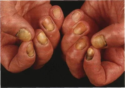 Фотографии грибка ногтей на руках в разных климатических зонах