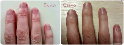 Изображение грибка ногтей рук среднего размера