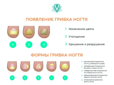 Грибок ногтей. Лечение удаление грибка на ногтях, на ногах.