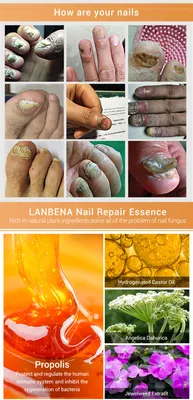 Фото грибка кожи рук: качественный контент для медицинских статей