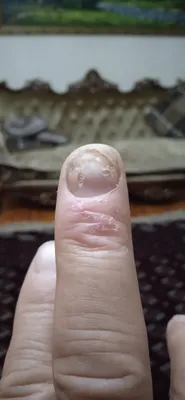 Фотография грибка кожи рук: симптомы и диагностика