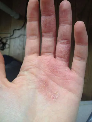 Фото грибка между пальцами рук: лечение народными средствами