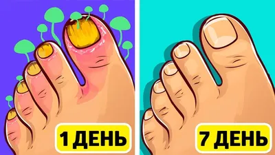 Изображения грибка между пальцами рук: как дезинфицировать обувь