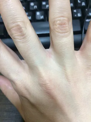 Картинка грибка между пальцами рук: макрофотография