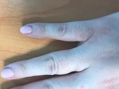 Картинка грибка между пальцами на руках: советы дерматолога