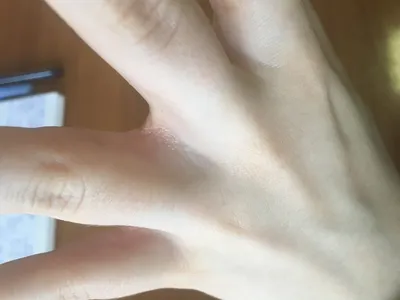 Фотография грибка между пальцами на руке: какой врач лечит