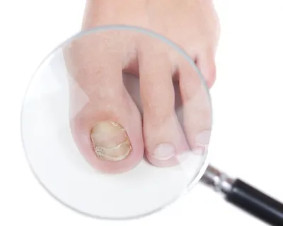 Изображение грибка между пальцами на руках: как диагностировать
