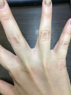 Фотография грибка между пальцами на руке: какие средства используются для лечения