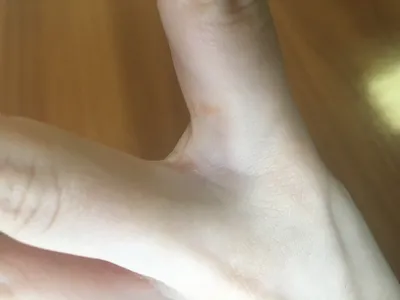 Картинка грибка между пальцами на руках: как не допустить распространения