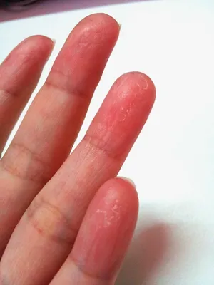 Фотография грибка между пальцами: лучшие средства от заболевания