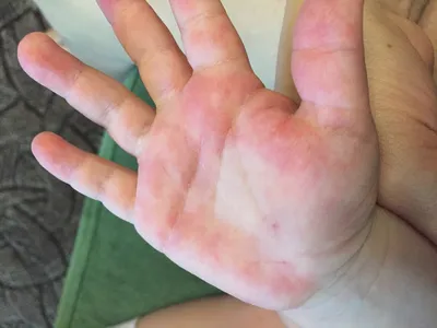 Фото грибка на коже рук: какие симптомы нужно знать для быстрой диагностики