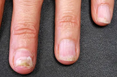 Изображение грибка на коже рук: симптомы и лечение