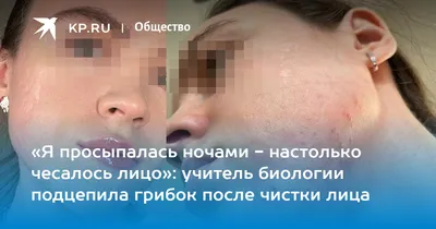 Я просыпалась ночами - настолько чесалось лицо»: учитель биологии подцепила  грибок после чистки лица - KP.RU