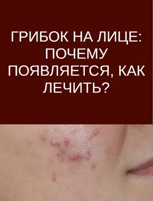 Советы | Лицо, Советы, Микоз