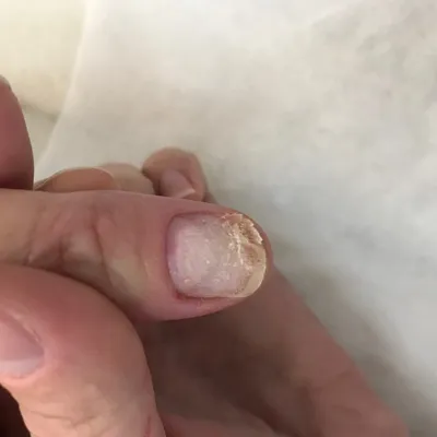 Фото грибка на ногте руки: лечение и профилактика