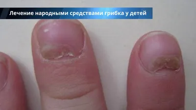 Фотографии грибка на ногте руки в формате JPG