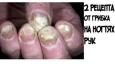 Фотография грибка на ногтях на руках для лекций по дерматологии