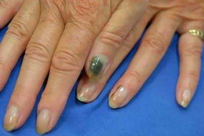 Фотка грибка на ногтях на руках для медицинской документации