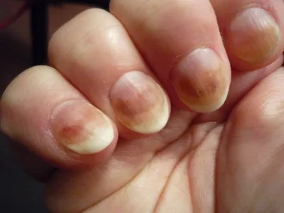 Фотография грибка на ногтях на руках для медицинского журнала