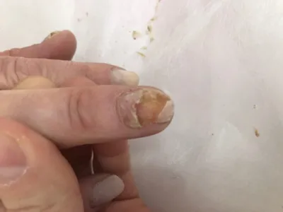 Фотография грибка на ногтях на руках для медицинской промышленности