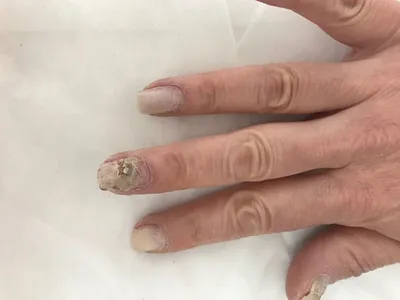 Фото грибка на ногтях на руках в формате PNG