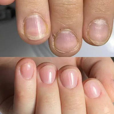 Грибок на ногтях на руках: фото для диагностики