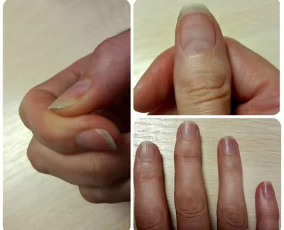 Изображение грибка на ногтях на руках: диагностика и лечение