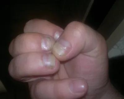 Грибок на ногтях на руках: фото для медицинских учебных заведений