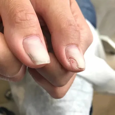 Фото грибка на ногтях на руках для статьи о заболевании