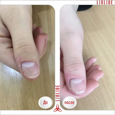 Фотография грибка на ногтях рук с рекомендациями врача