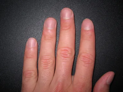Грибок на ногтях рук: фото современных методов лечения