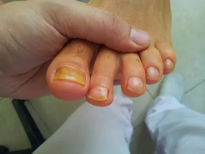 Картинка грибка на ногтях рук начальной стадии в высоком разрешении