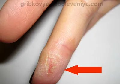 Невероятное фото грибка на подушечках пальцев рук