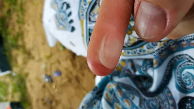 Уникальное фото грибка на подушечках пальцев рук