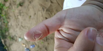 Фото грибка на подушечках пальцев рук в высоком разрешении