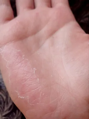 Фото грибка на подушечках пальцев рук в формате WebP