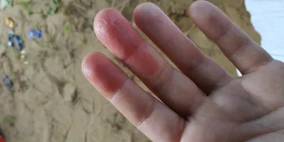 Фотография грибка на подушечках пальцев рук для скачивания