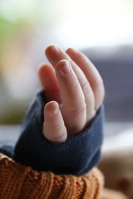 Фотография грибка на руках у ребенка: как распознать заболевание