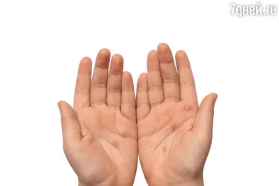 Фото грибка на руке с объяснением процесса заражения