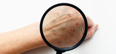 Фотография руки с грибком: пример дерматологического заболевания