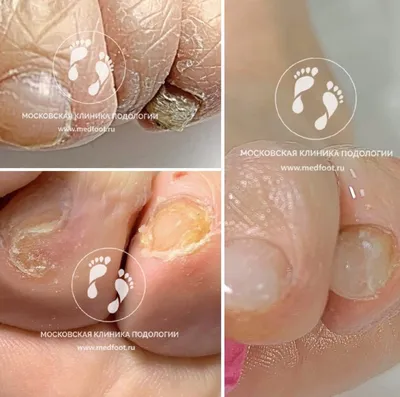 Изображения грибка ногтей на руках: какие заболевания могут спровоцировать грибок