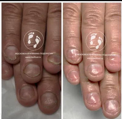 Лечение грибка ногтей на руках: фотографии до и после
