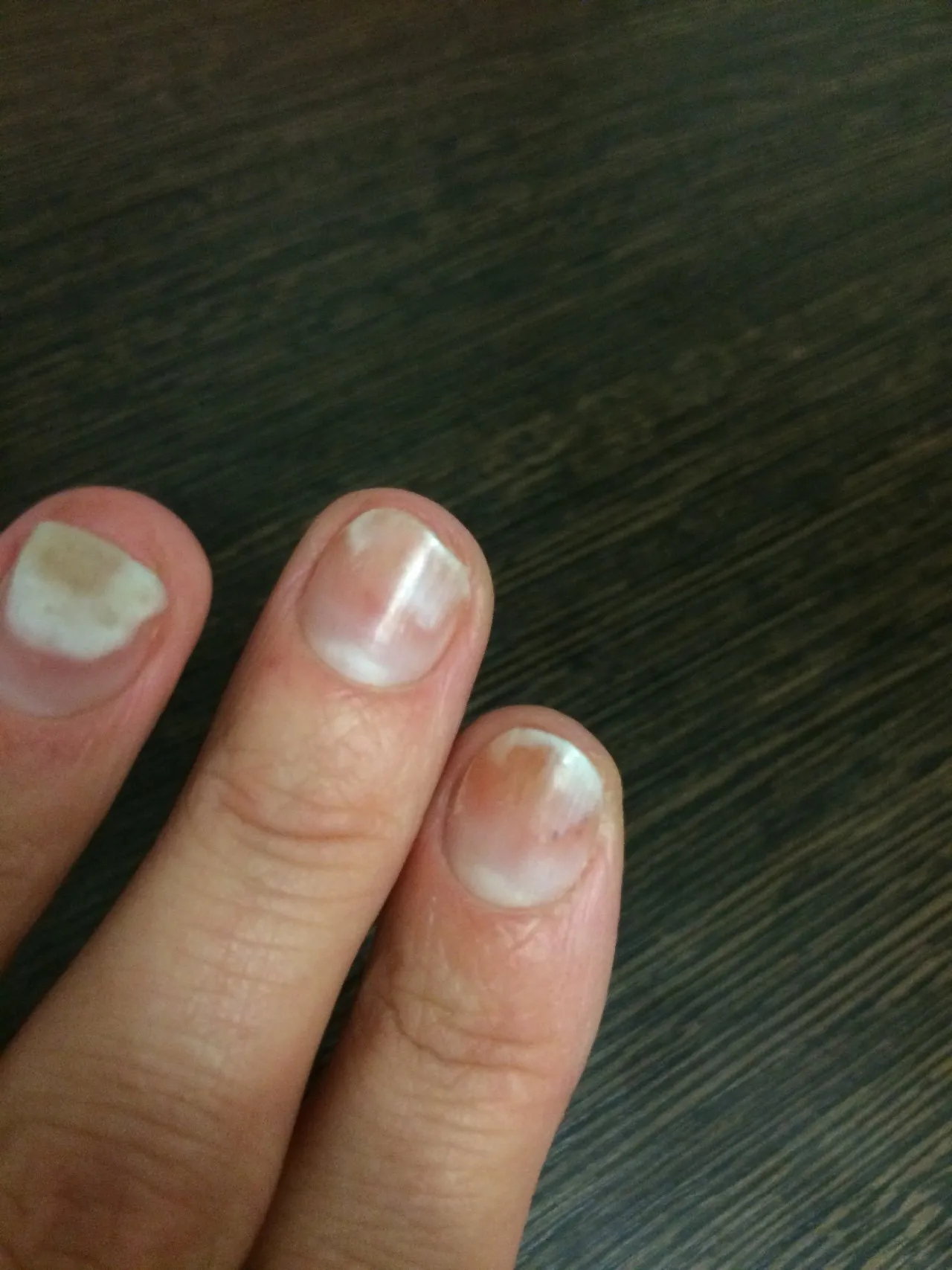 Грибок ногтей онихолизис