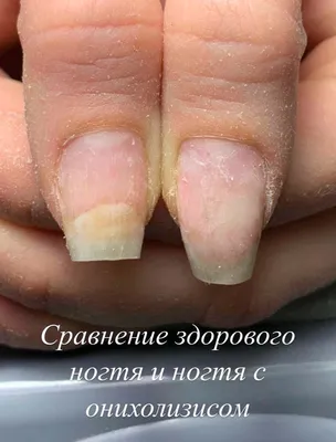 Изображения грибка ногтей на руках: как поддерживать здоровье ногтей