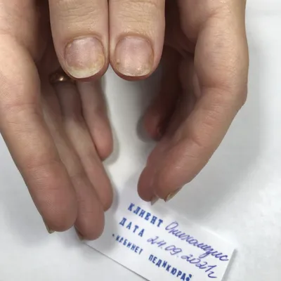Фотографии грибка ногтей на руках: как изменяется внешний вид ногтей при болезни