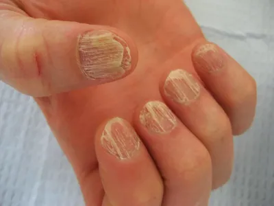Фотографии грибка ногтей на руках: как выглядит болезнь