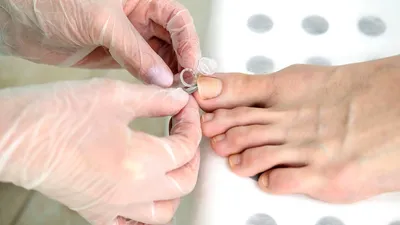 Изображения грибка ногтей на руках: какие ошибки нельзя допустить при лечении болезни